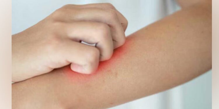 متى تحتاج إلى طبيب بسبب طفح جلدي؟