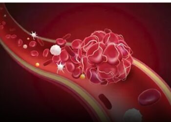 كيف يزيد التدخين عادة خاطئة من خطر الجلطات الدموية؟