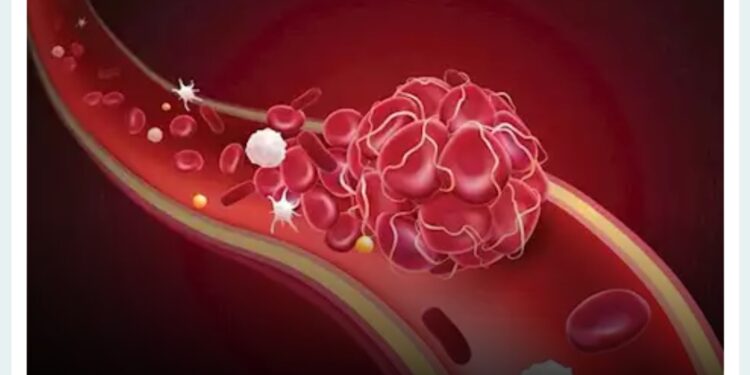 كيف يزيد التدخين عادة خاطئة من خطر الجلطات الدموية؟