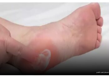 آلام كعب القدم : أسبابه وأعراضه وطرق الوقاية