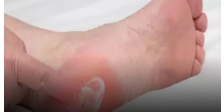 آلام كعب القدم : أسبابه وأعراضه وطرق الوقاية