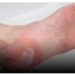 آلام كعب القدم : أسبابه وأعراضه وطرق الوقاية