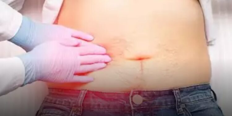 دور المرارة في الجهاز الهضمي وكيفية التعامل بعد استئصالها