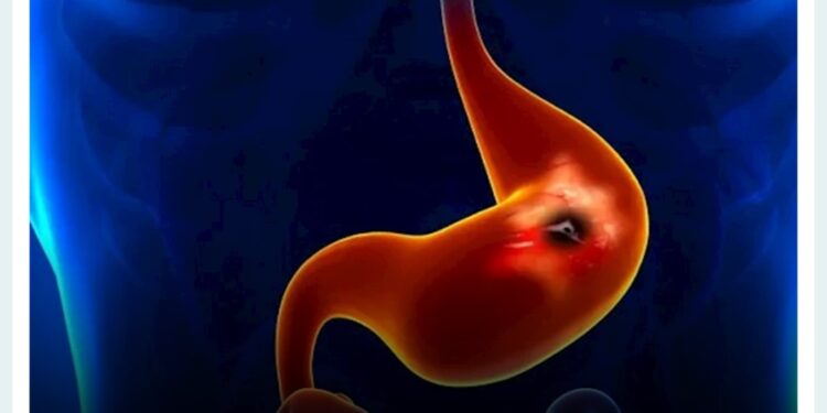 تسبب قرحة المعدة .. تجنب هذه الأطعمة في سحور رمضان 