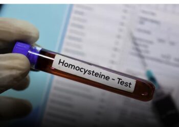 لماذا ينصح الأطباء بتحليل الهوموسيستين؟