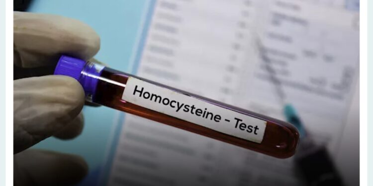 لماذا ينصح الأطباء بتحليل الهوموسيستين؟