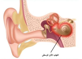 أعراض التهاب الأذن الوسطى وطرق الوقاية الفعالة