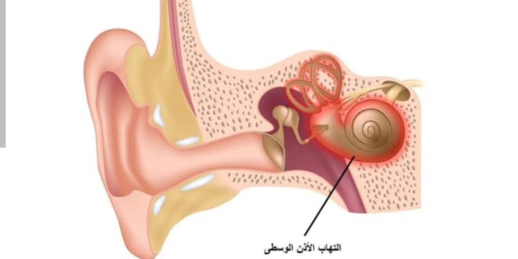 أعراض التهاب الأذن الوسطى وطرق الوقاية الفعالة