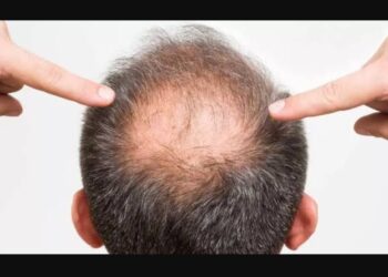 كيف تواجه الصلع الوراثي بخطوات عملية في 2025