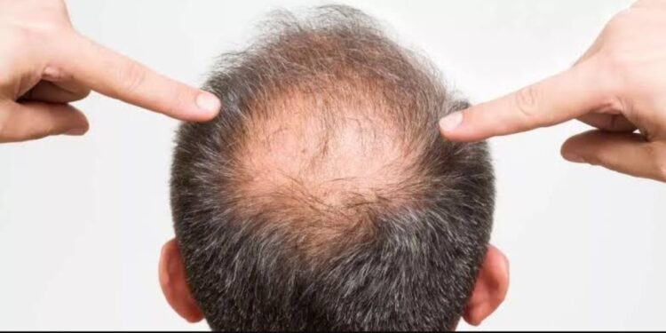 كيف تواجه الصلع الوراثي بخطوات عملية في 2025